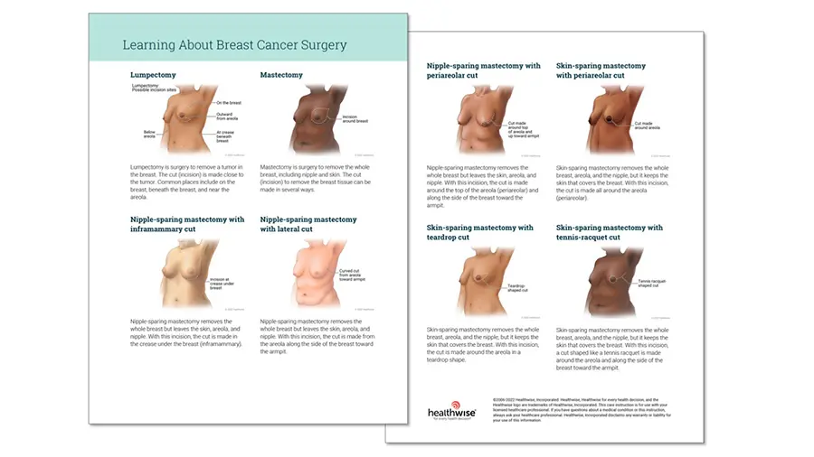 A patient instruction sheet titled "Learning About Breast Cancer Surgery" that shows different types of mastectomy surgeries on different people, showing a variety of skin tones.